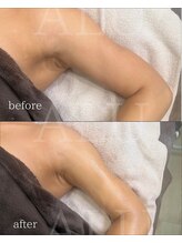 アルフォービューティー 難波店(ALU for beauty)/二の腕オンダリフト症例