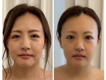 アンドモア(&more)/小顔症例