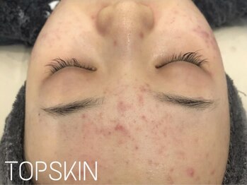 トップスキン 新宿(TOPSKIN)/しつこい大人ニキビも根本改善!