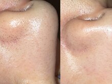 クリアー(CLEAR.)/【Before＆After】