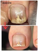 エンヴィ(ENVY)/巻爪ケア