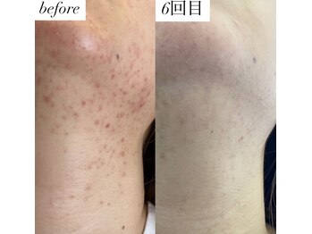 ロンド(Lond)/BBLで肌質改善♪効果