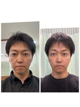 あらた鍼灸整骨院/メンズ美容鍼