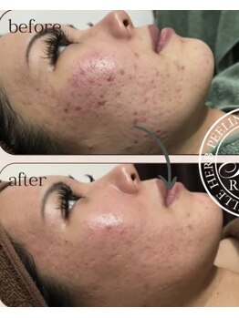 セレネ(SELENE)/シフォンピーリング