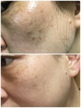 シーカラー 中野栄店(C.color)/ハーブピーリング