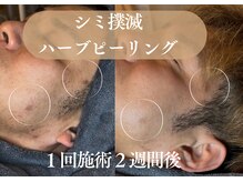 アルト(ALTO)の雰囲気（濃いシミが一度で驚きの効果！）