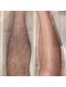 【メンズ両腕・両足脱毛】25000円★半袖＆短パンを堂々と！圧倒的清潔感