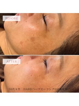 ジュエルカラーズ(JEWEL COLORS)の写真/【40代からのシミ・くすみ・ハリ不足に】オーダーメイドHARDハーブピーリング