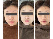 ナンバーナイン(NO.NINE)/小顔ドライヘッドスパ×瞬間筋膜