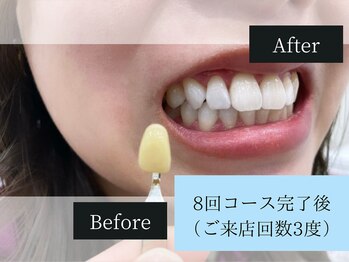 ホワイトニングカフェ アスピア明石店(WhiteningCafe)/◎歯のホワイトニング施術写真◎