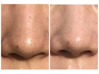 プレジール(PLAISIR)/いちご鼻撃退!ハイドラ毛穴洗浄