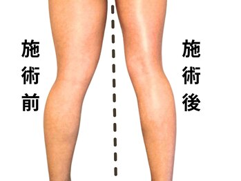 ニュートラル 池袋店(NEUTRAL)/施術結果【痩身/筋膜】