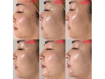 小顔アンドエイジングケア専門店 ビゼ(美sser)/REVIハーブピーリング