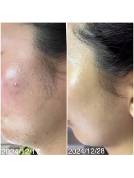 ラブリボン/ニキビケア