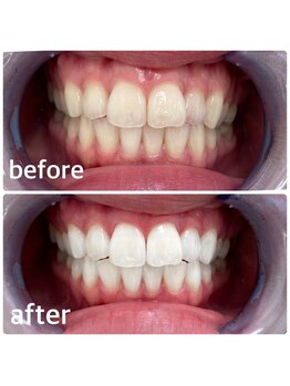 コナホワイトニング 神保町/初回お試し