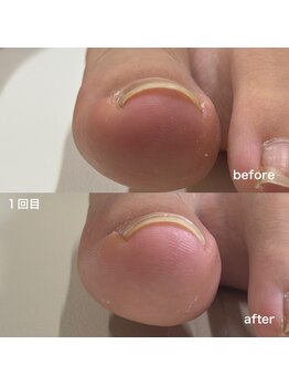リリ(lili)/巻き爪矯正1回目(左親指)