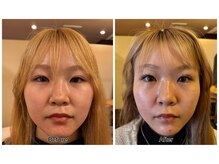 はやしだ鍼灸整骨院/美容鍼3回施術後→顔のむくみ◎