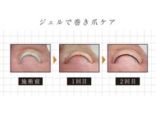 カールズネイル ゆめタウン高松店の雰囲気（ジェルの力で巻き爪をやさしくケア。食い込みを整え自然な爪へ♪）