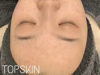 トップスキン 新宿(TOPSKIN)/ニキビだけでなくシミ美白効果も