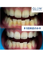 グロウ 上野店(GLOW)/5回来店BeforeAfter【6】