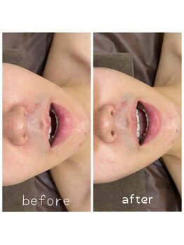 サロンシファ(salon sifa)/術後ケア