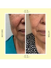 アフロディーテ(Aphrodite)/エクソリフト