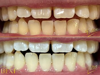 ベクスト(BEXT)/セルフホワイトニング