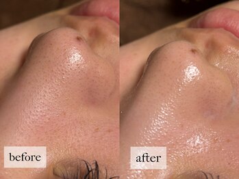 ヒナノ 矢場町店(HINANO)/ハイドラ毛穴洗浄