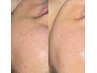 【肌が綺麗になるフェイスwax(全顔)】ハイドロジェリーマスクでお仕上げ♪