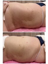 クリニカルエステ/イーズ パークプレイス大分店/#レモンボトル　導入１回の変化