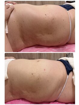 クリニカルエステ/イーズ パークプレイス大分店/#レモンボトル 導入1回の変化