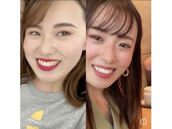 エクシアホワイトニング 代々木店/ホワイトニングするなら代々木で