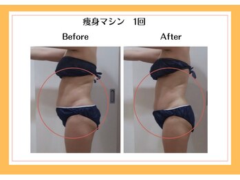 リヴェーヌ 富山店/トリプル痩身全身1回