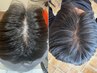 【男女/育毛促進】分け目,生え際が気になる方必見!!幹細胞導入でボリュームUP