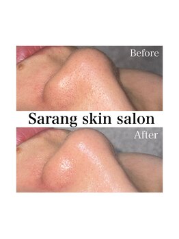 Sarang skin salonの写真/《感動の毛穴管理》皮脂汚れをごっそり洗浄！クレンジング×美容液導入で、思わず触れたくなる艶肌を実感！