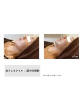 サニーブランシュ(SUNNY blanche)/光フェイシャルで美肌へ