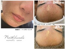 ノースフェイシャルズ(North facials)