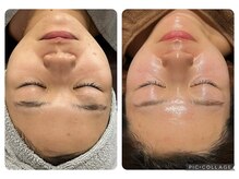 リノア(Lino'aka)/セルマン サロンケア3回目