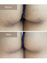 エミルカ 千葉店(EMILUCA)/ハーブピーリングお尻/黒ずみ