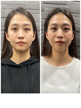 長寿鍼灸院 長寿整骨院/美容鍼50本の効果★ハリ・ツヤ