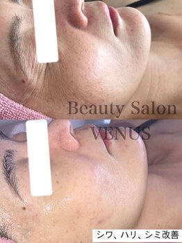 ヴィーナス(Venus)/白玉スキンハーブピーリング