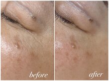 アウラ(Aula)/気になる目元の小じわ