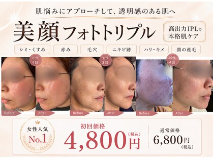 トレースの写真
