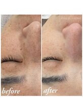 エクラデボーテ(eclat de beaute)&nbsp;before after