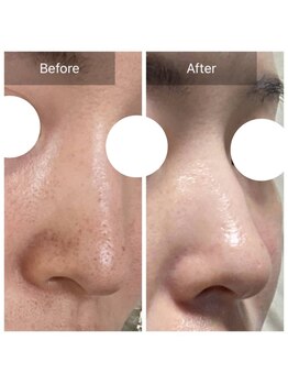 ダリア(Dahlia)/毛穴の開き、黒ずみが気になる方