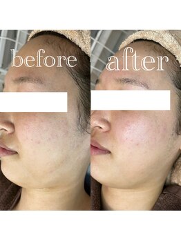 カラン(Calin)/ダイヤピーリング→ビタミンC＋A