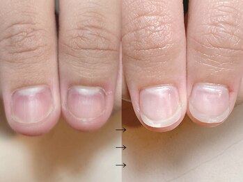 深爪矯正 自爪風長さ出し