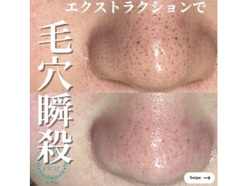 ミラーヴ(MERAVE)/開き毛穴もお任せ！！