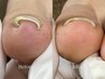 巻き爪ケア【軽度～強めの巻き爪対応可◎】※初回プレート装着費+5500円