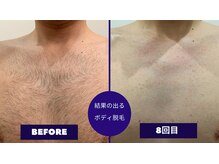 フェイシャル専門サロン サロン ド ウイッシュ/メンズボディ脱毛